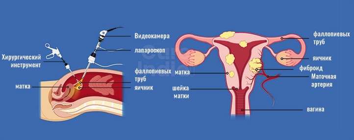 лапароскопическое удаление миомы матки